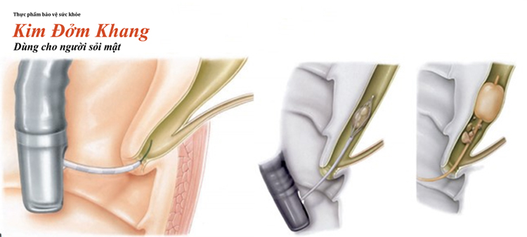 Nội soi mật tụy ngược dòng vừa giúp chẩn đoán, vừa giúp điều trị sỏi ống mật chủ